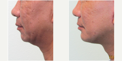 45-54 year old man treated with Mini Lift and Chin Augmentation - This gentleman presented to Center with the request of improving his jawline and small chin. Evaluation revealed an undersized chin along with sagging tissue along the lower face and jawbone (producing jowls). We agreed that tastefully increasing the size of the chin, along with tightening both the muscle and skin of the lower face (a.k.a. Minilift/Mini-Facelift), would create natural balance. Both procedures were performed in the same session under local anesthesia (with mild oral sedation with valium) in our Center. Procedure time was slightly under two hours. He returned to both work and the gym one week after procedure.