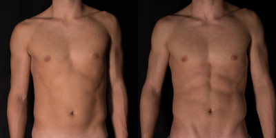 25-34 year old man treated with Vanquish - Patient was concerned with stubborn areas of abdominal fat and was treated with Vanquish, Exilis Ultra and Cellutone treatments.