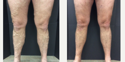 Venaseal for Varicose Veins - This patient had Venaseal done on both legs, as well as a phlebectomy and varithena. Venaseal is one of the newest ways to treat varicose veins, and the patients love it because there is no downtime with great results.