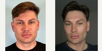 3 Weeks Post- Op: Buccal Fat Removal, Jawline Sculpting and Perioral Mound - 35-44 year old man treated with Buccal Fat Removal, Jawline Sculpting and Perioral Mound