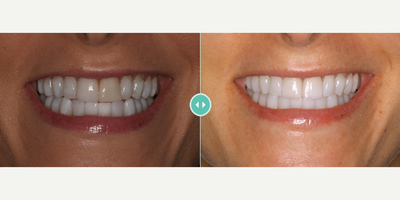 Woman treated with Porcelain Veneers - Woman treated with Porcelain Veneers