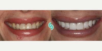 Woman treated with Porcelain Veneers - Woman treated with Porcelain Veneers
