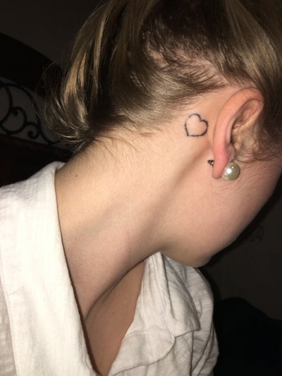 Will my tattoo easily be removed? (Photo) Doctor Answers, Tips