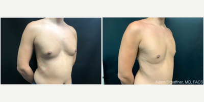Man treated with Liposuction - Man treated with Liposuction.