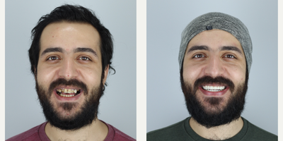18-24 year old man treated with Smile Makeover, Porcelain Veneers, Full Mouth Reconstruction - The health condition and appearance of existing teeth of our patient were not good. Full mouth smile makeover has been applied using veneer crowns.