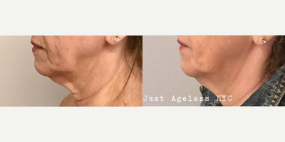 EndyMed 3Deep - Woman treated with EndyMed 3Deep