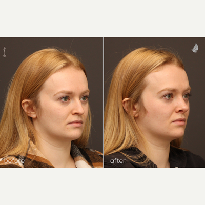 Rhinoplasty - 27 year old patient who is 1 months out from a rhinoplasty and can expect to see continued improvement in definition of the nasal tip