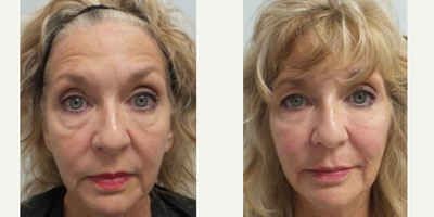 64 year old woman treated with Restylane Lyft - She had 2 syringes of Restylane Lyft in each cheek, and Restylane Silk in lips. This was done with blunt cannulas so there is no bruising or swelling. The after picture is done right after completion.
