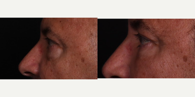 55-64 year old man treated with Eyelid Surgery, Facial Fat Transfer - Lower blepharoplasty with fat grafting B&A.