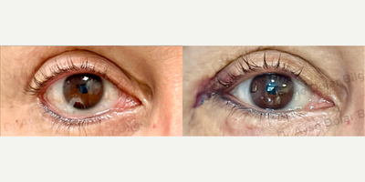 Woman treated with Eyelid Surgery, Eyelid Retraction Repair - Lower eyelid retraction is one of the most challenging complications following midface and lower eyelid surgeries. Surgical approaches should be tailored to each patient to address the underlying cause of the retraction.