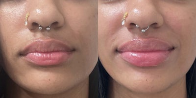 19 year old woman treated with Restylane Contour - This 19-year-old patient enhanced her natural beauty with Restylane Contour for lip augmentation. The before image shows her lips with a lovely natural shape but lacking a bit of volume. In the after image, her lips appear fuller and more hydrated, with enhanced definition while still maintaining a natural, balanced look. Restylane Contour provides a soft and subtle enhancement, perfect for youthful and elegant results.