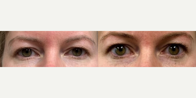 Woman treated with Sofwave - Woman treated with Sofwave