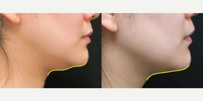 Woman treated with ULTRAcel - Woman treated with ULTRAcel