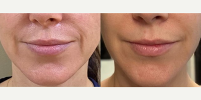 Woman treated with Sofwave - Woman treated with Sofwave