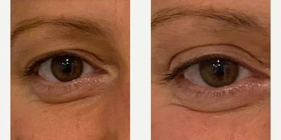 Woman treated with Sofwave - Woman treated with Sofwave