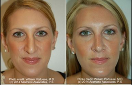 Rhinoplasty and Chin Implant - Rhinoplasty and Chin Implant
