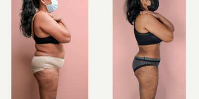 55-64 year old woman treated with Liposuction, Tummy Tuck - This lovely patient requested help in improving her shape and removing the sagging skin from her abdomen. She was able to turn back the clock and look 30 years younger with a combination of tummy tuck and 360 liposuction.