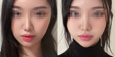 18-24 year old woman treated with Lipodissolve - Fat-dissolving injections to contour the facial line