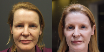 45-54 year old woman treated with Forehead Reduction Hair Line Lowering and Rounding - She didn't like her high receding forehead corners that looked too masculine.  She did not want the scar on her hair line associate with a forehead reduction surgery. She also wanted the corners to be more rounded in appearance which a forehead reduction surgery could not achieve.