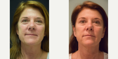 55-64 year old woman treated with Ultherapy - 55-64 year old woman treated with Ultherapy on the lower face just 3 months after treatment. Full results can be expected at 6 months. This patient also followed a custom skincare regime.