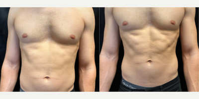 25-34 year old man treated with Evolve - Treated areas: abdominal area, arms