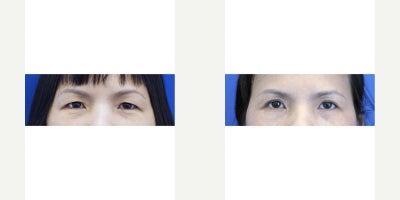 35-44 year old woman treated with Double Eyelid Surgery - This lady has double eyelid crease but very thin and hidden underneath the droopy skin. In office asian blepharoplasty under local anesthesia creates an optimum environment for eyelid crease revelation.