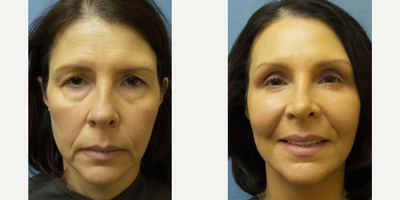 45-54 year old woman treated with Cheek Lift, Facelift,  Upper/Lower Eyelids and Septo-Rhinoplasty - 45-54-year-old woman treated with Cheek Lift, Facelift, Upper/Lower Eyelids and Septo-Rhinoplasty