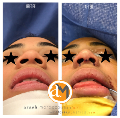 18-24 year old female treated with Rhinoplasty - Our client had a rhinoplasty to change the overall shape of her nose by narrowing the nasal base (nostril width) and narrowing the nasal tip.