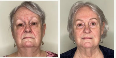 65-74 year old woman treated with Agnes RF, Microneedling RF, Dermal Fillers - Full Face Rejuvenation With Dermal Fillers and RF MicroneedlingFull face rejuvenation can be effectively achieved using a customized combination approach. Dermal fillers are used to improve nasolabial folds, soften marionette lines, enhance lip volume, and refine chin projection for better facial balance and contour. To further enhance results, RF microneedling helps tighten the skin, improve texture, and reduce redness associated with rosacea by stimulating collagen remodeling. This multi-modal treatment approach delivers natural-looking, long-lasting facial rejuvenation with improved skin tone, firmness, and overall harmony.