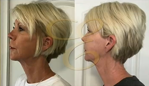 Woman treated with Skin Tightening - Woman treated with Skin Tightening