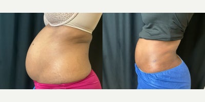 45-54 year old woman treated with Tickle Lipo - Tickle Lipo