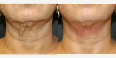 ThermiSmooth Treatment - ThermiSmooth on the neck