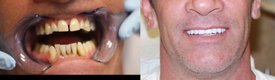40 year old Male treated with All-on-4 Dental Implant Procedure - 40 year old Male (severe perio) treated with All-on-4 Dental Implant Procedure