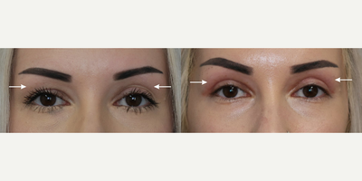 Woman treated with Botox - Woman treated with Botox