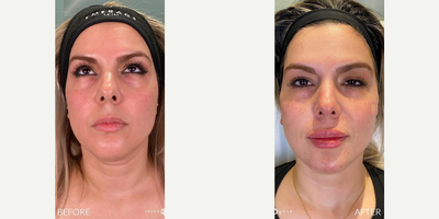 Woman treated with Renuvion - Woman treated with Renuvion