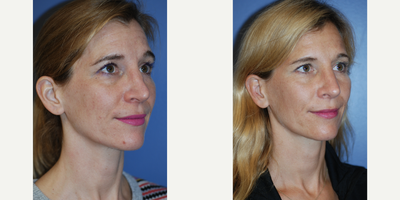 35-44 year old woman treated with Revision Rhinoplasty - 44 year old female undergoing rhinoplasty