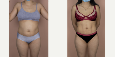 25-34 year old woman treated with Brazilian Butt Lift & Hi-Def Liposuction - This is a young mother who wanted to reclaim her youthful body, which had changed significantly after pregnancy. She wanted to look more athletic and have a fuller buttock. She underwent a 360Lipo with Vaser Hi-Def sculpting and fat transfer. Now, she can't stop showing off her beach body!