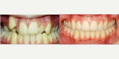 18-24 year old woman treated with Damon Braces - Damon Braces Treatment