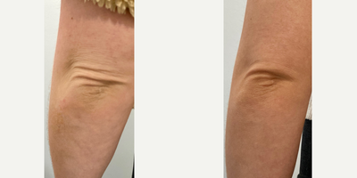 35-44 year old woman treated with Genius - Before & 6 weeks after 1 Genius treatment on the elbows to improve skin quality.