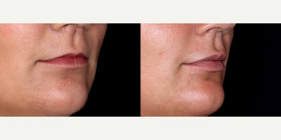 24year old woman treated with Volbella - 24 year old woman treated with Volbella, Lip Fillers. Photos depict before and 1 month after treatment.