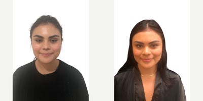 35-44 year old woman treated with Buccal Fat Removal - 36 y.o female who was concerned with fullness in her lower face and underwent buccal fat reduction under local anesthesia. She has more defined cheek with tapered lower face