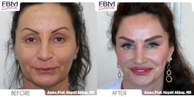 55-64 year old woman treated with Deep Plane Facelift, Neck Lift, Eyelid Surgery, Lip Lift - 55-64 year old woman treated with Deep Plane Facelift, Neck Lift, Eyelid Surgery, Lip Lift
