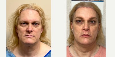 45-54 year old woman treated with Forehead Reduction, Brow Lift, Septoplasty, Rhinoplasty, Lip Lift, Lip Surgery, Adam's Apple R - This is a lady who underwent forehead feminization, septorhinoplasty, lip lift with augmentation, and chin feminization.