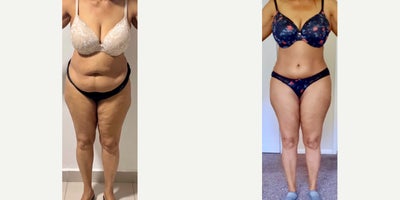 25-34 year old woman treated with Tummy Tuck, Liposuction, Brazilian Butt Lift - Excellent outcome after full tummy tuck combined with intense liposuction including abdomen, waist, laterals and upper and lower back to improve your body contour and get better curves, especially in your waist area and dominican butt lift.