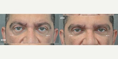 35-44 year old man treated with Eyelid Retraction Repair, Dermal Fillers - Eye doctor with bulding eyes, flat cheeks, negative vector, lower eyelid retraction, round eyes, and tired eyes underwent treatment for a more relaxed, confident, and rested appearance with almond eyes. Im especially humbled and grateful when my patients are eye doctors who trust me with their care.