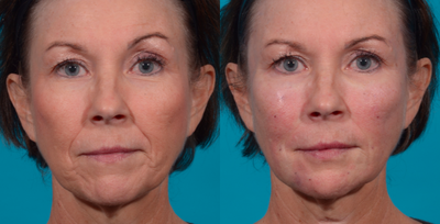 55-64 year old woman treated with Liquid Facelift - 1 Kit BellaFill liquid facelift