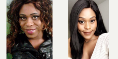 25-34 year old woman treated with Facial Feminization Surgery - 25-34 year old woman treated with Facial Feminization Surgery