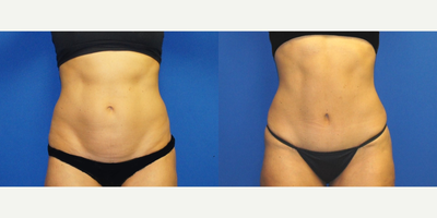 53 year old woman treated with Mini Tummy Tuck and Contour Liposuction - 53 year old mother of 2 who complained of a bulging abdomen with minimal skin excess.  She was unable to improve her abdominal contour with healthy diet or vigorous exercise.  She sought consultation for cosmetic improvement of her lower abdominal and flank areas.  With her unique anatomy (minimal skin excess, good muscular tone, belly button highly placed on the abdominal wall) she was a good candidate for a Mini Tummy Tuck with Contour Liposuction.  This procedure was performed and she was back to a light exercise routine in 2.5 weeks and back to her pre-procedure exercise program 6 weeks after her procedure.  She is very happy with her results and remains an avid Pilates and hot yoga participant.