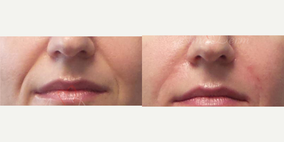 35-44 year old woman treated with Juvederm, Radiesse, Vollure, Restylane, Bellafill - Treatment of nasolabial folds with Juvederm, Radiesse, Vollure, Restylane, Bellafill or RHA injected with cannula