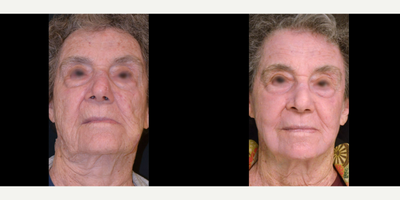 65-74 year old male treated with TotalFX - DeepFX to peri-oral + peri-orbital, ActiveFX to full face